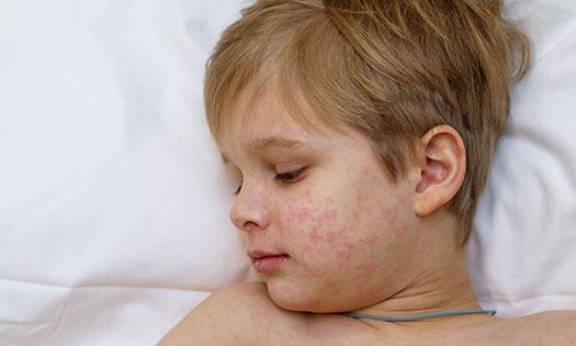 Measles facts: 8 myths debunked