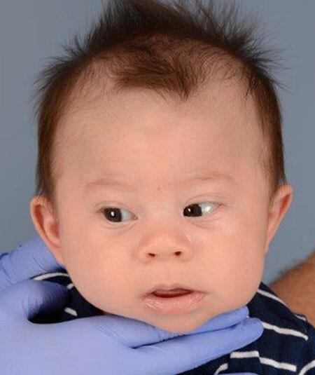 Dexter Osborne (DOB 5/20/2017)  had metopic craniosynostosis and underwent strip craniectomy surgery using limited incision technique.