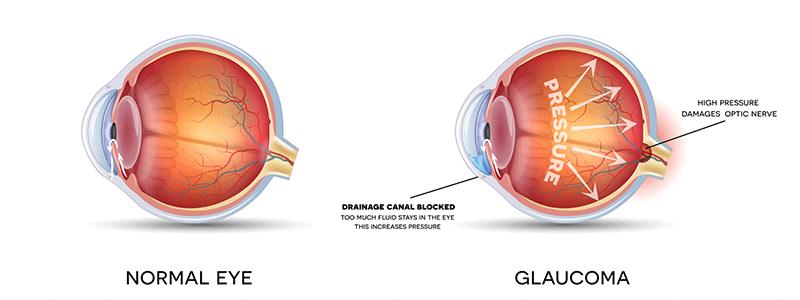 Shutterstock_327062303-Glaucoma-800x300