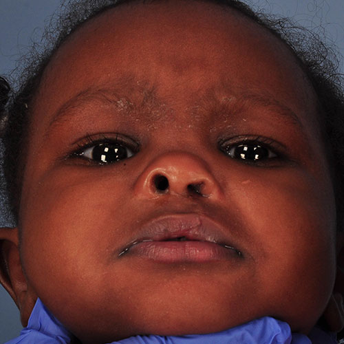 Marib Mohamei DOB 1/11/2017 after  Unilateral Cleft Lip and Palate surgery