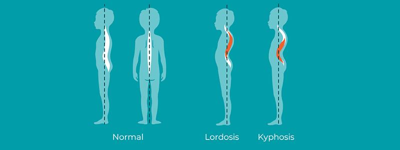 Shutterstock_1038699856-Lordosis-and-Kyphosis-800x300