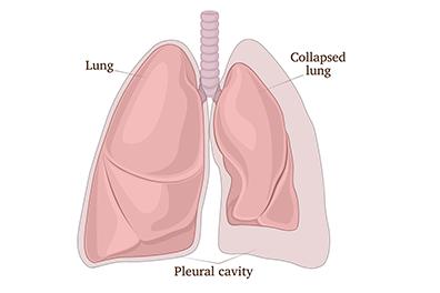 Shutterstock_1249822588-Collapsed-lung-396x264