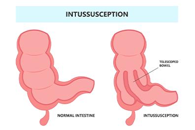 Shutterstock_2133437449-Intussusception-396x264