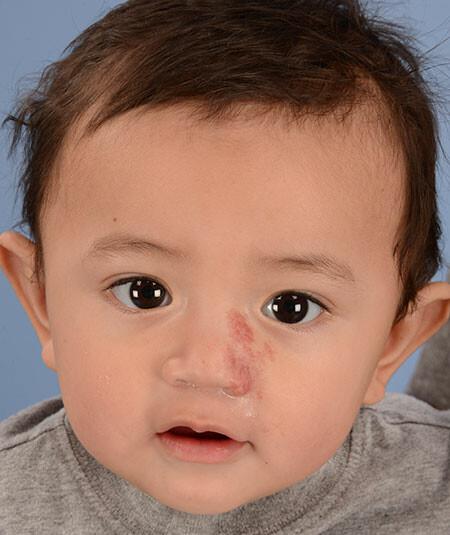 Christopher (DOB 6/24/2013) had a left nasal hemangioma that was treated with propranolol as well as 2 laser treatments. There are 3 additional photos of different angles being used. (After)