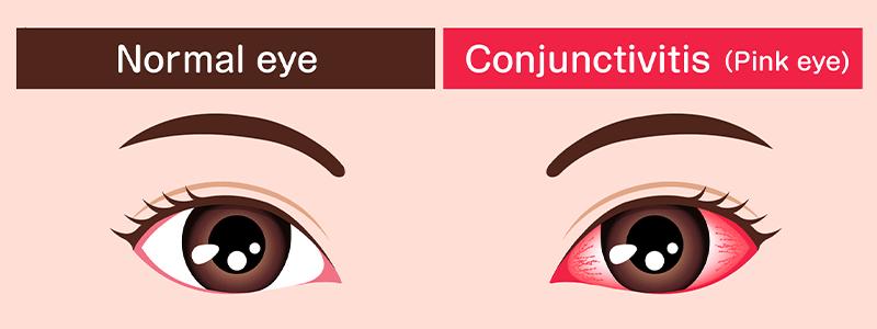 Shutterstock_1807301557-Pink-Eye-800x300