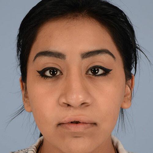 Daisy Rodriguez DOB 9/3/1997 most recently underwent Lefort I maxillary osteotomy and advancement with Dr. Smartt . 3 additional photos are used at different angles.