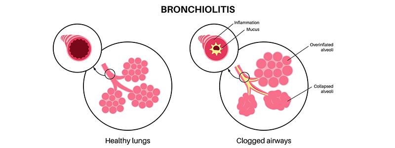 Shutterstock_2288417491_Bronchiolitis-800x300
