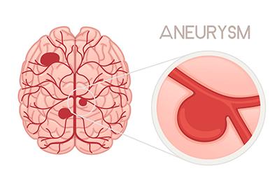 Shutterstock-2171173339-Brain-Aneurysm-396x264