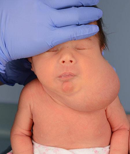 Heather Chadwick (DOB 10/19/2000) Venolymphatic malformation of the left neck