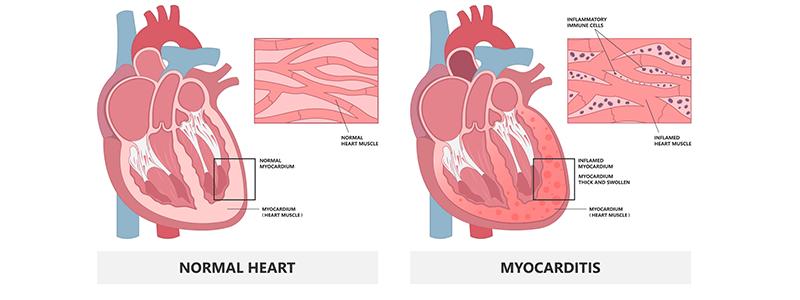 Shutterstock_2148274703-Myocarditis-800x300