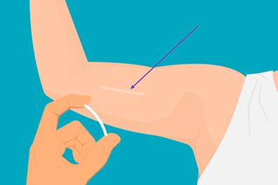 Shutterstock_1770038474-Nexplanon-396x264